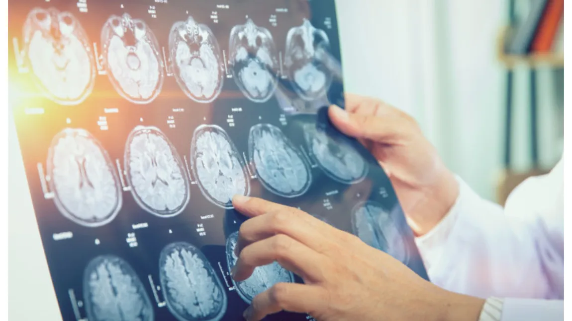Un bărbat a trăit ani de zile cu o tenie în creier. Medicii au fost şocaţi de descoperirea făcută