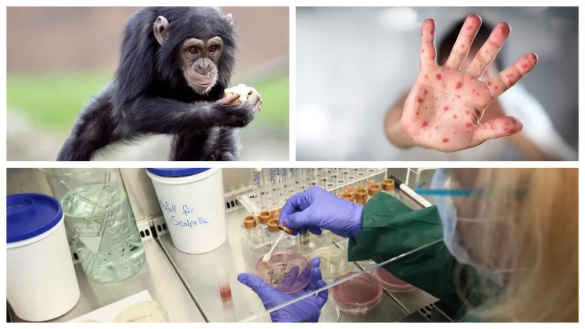Al şaselea caz de variola maimuţei a fost depistat în România. Ministerul Sănătăţii, în alertă