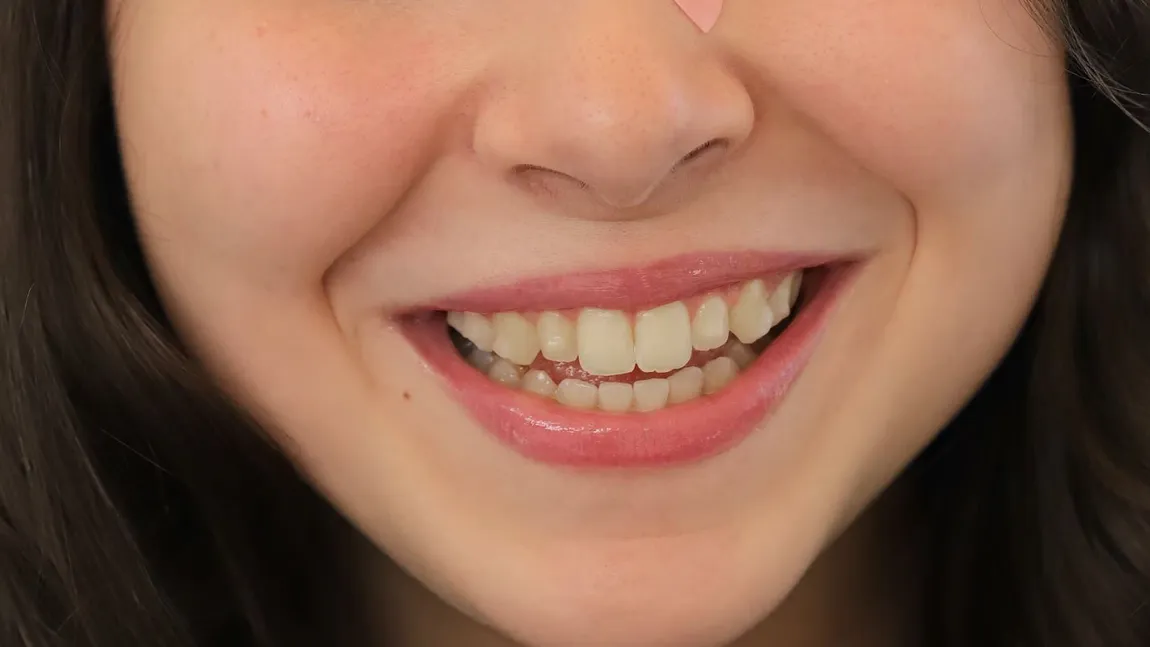 Cauzele dinților galbeni. Sfaturi utile și metode de tratament