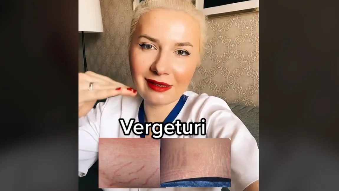 Cum poţi scăpa de vergeturi. Medicul Gabriela Bud a dezvăluit soluţia: 