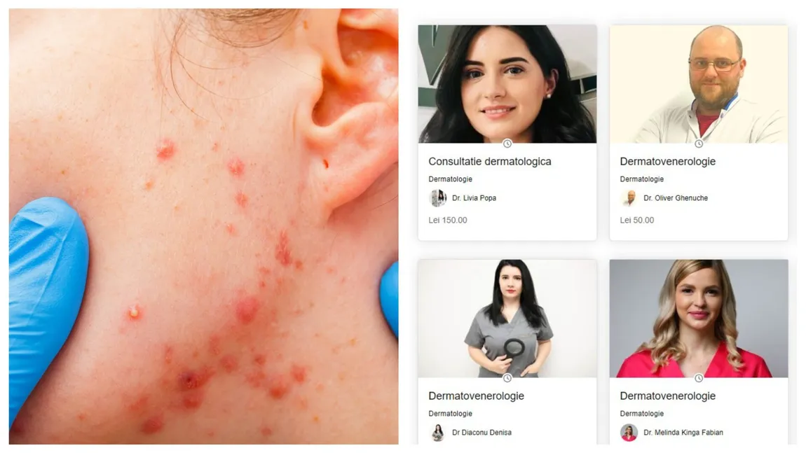 Copilul tău adolescent suferă de acnee? Ajută-l să-i dea CANCEL cu ajutorul medicilor dermatologi