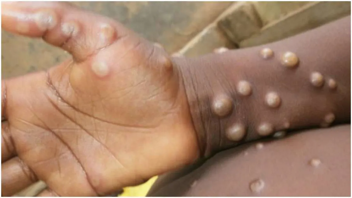 Primul deces cauzat de variola maimuţei a avut loc în India. Tânărul se întorsese recent din Emiratele Arabe Unite