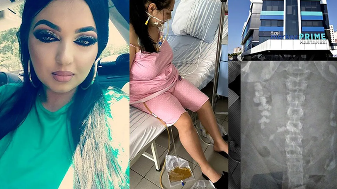O româncă de 32 de ani, la un pas de moarte după o operație de micșorare a stomacului în Turcia: 