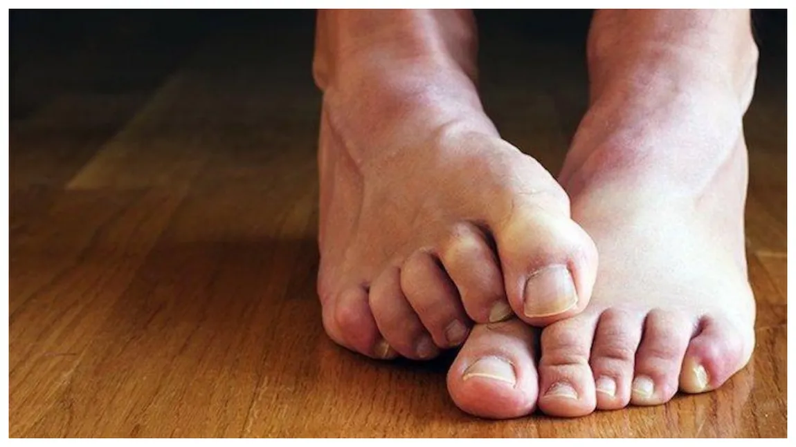 Ciuperca unghiei piciorului - cum apare și ce tratamente există?