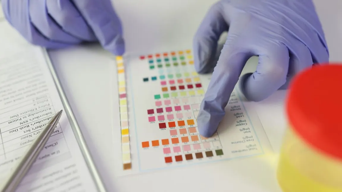 Impactul acidului ascorbic asupra rezultatelor testelor de urină 