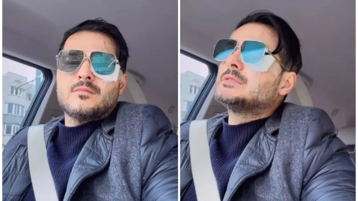 Liviu Vârciu și-a panicat fanii după ce a apărut cu un ochi bandajat. Ce a pățit artistul: 