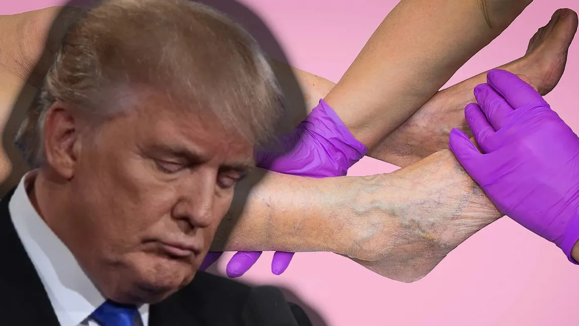 Donald Trump, diagnosticat cu insuficiență venoasă cronică. Ce presupune afecțiunea și cum se tratează