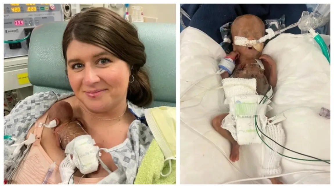 Minune medicală! O americancă a născut “cel mai prematur copil din lume”, la doar trei luni și o săptămână! E mic cât o palmă și cântărește 280 de grame!
