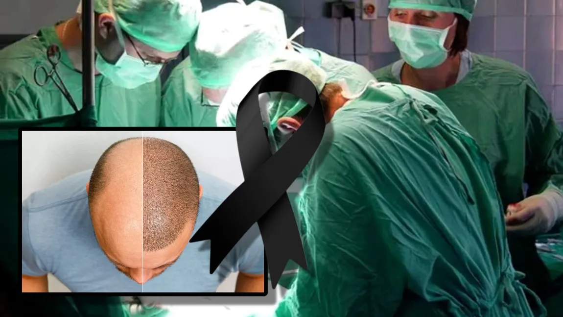 Un bărbat a murit după ce și-a făcut un transplant de păr în Turcia