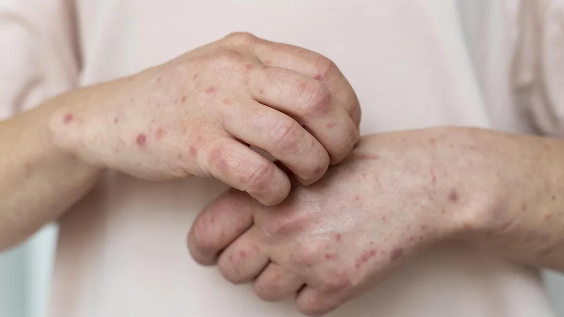 Ce simptome are lepra și cum se transmite. Ce trebuie să știi despre boala Hansen, cât de periculoasă este