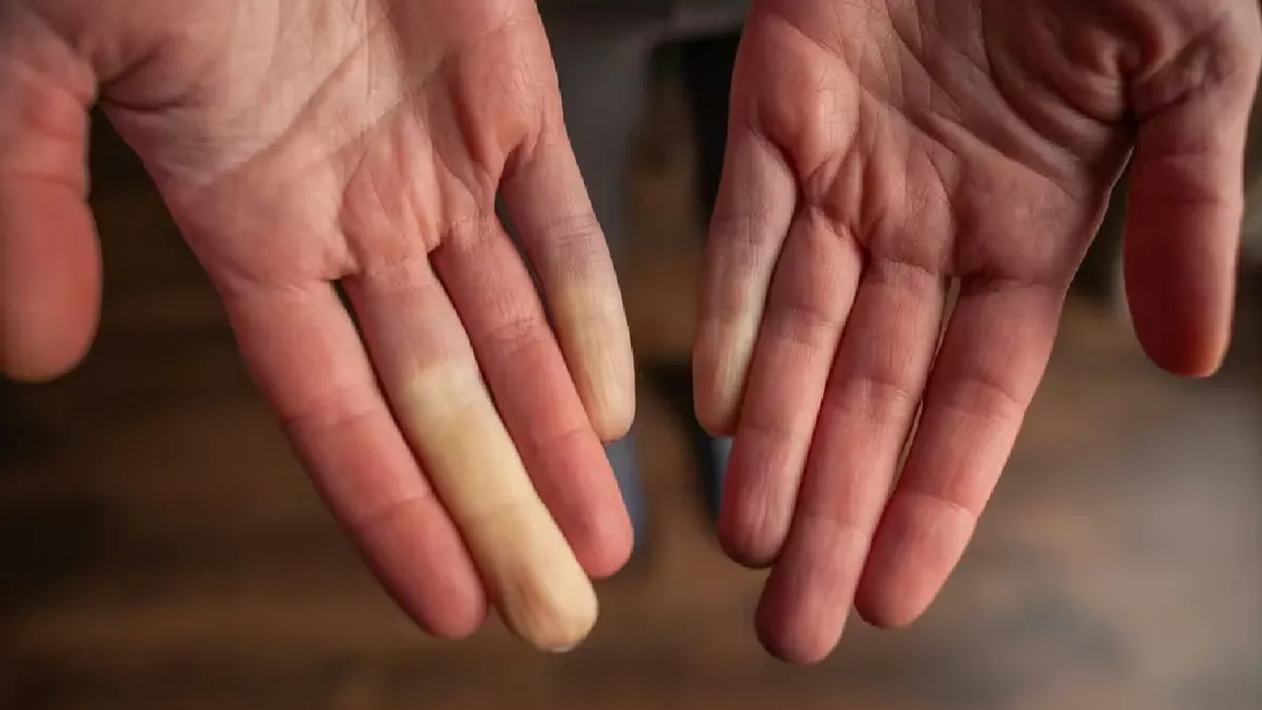 Boala semnalată de mâinile reci. Cum îți dai seama că nu e vorba despre o reacție la temperaturile scăzute