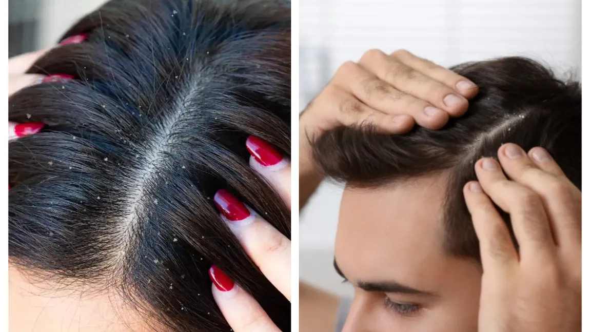 Cele mai bune trucuri care te ajută să scapi de mătreață pentru totdeauna. Ce să faci ca să ai un scalp sănătos