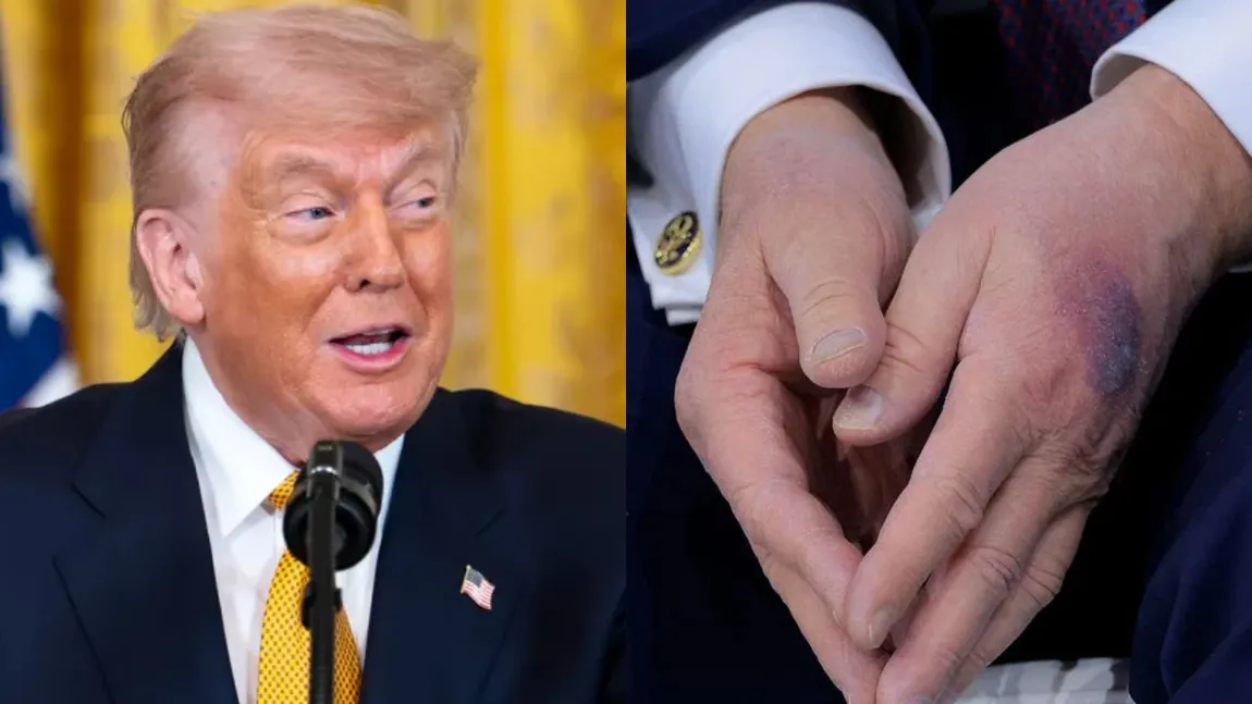 Donald Trump va efectua controlul medical anual pe 26 mai. Tot mai multe întrebări despre starea de sănătate a președintelui după ce a fost văzut cu vânătăi pe mâini