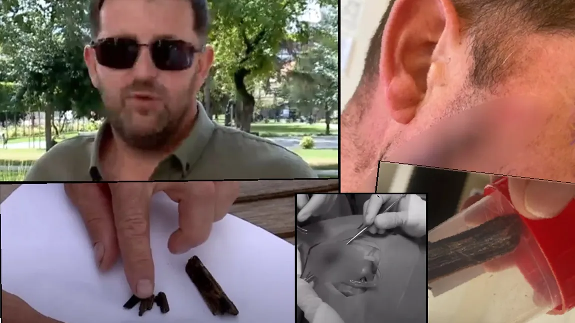 Caz medical șocant! Un sătmărean a ajuns de urgență la spital după ce medicul care l-a operat, un ginecolog, i-a uitat o bucată de lemn în față. A depus o plângere de malpraxis VIDEO