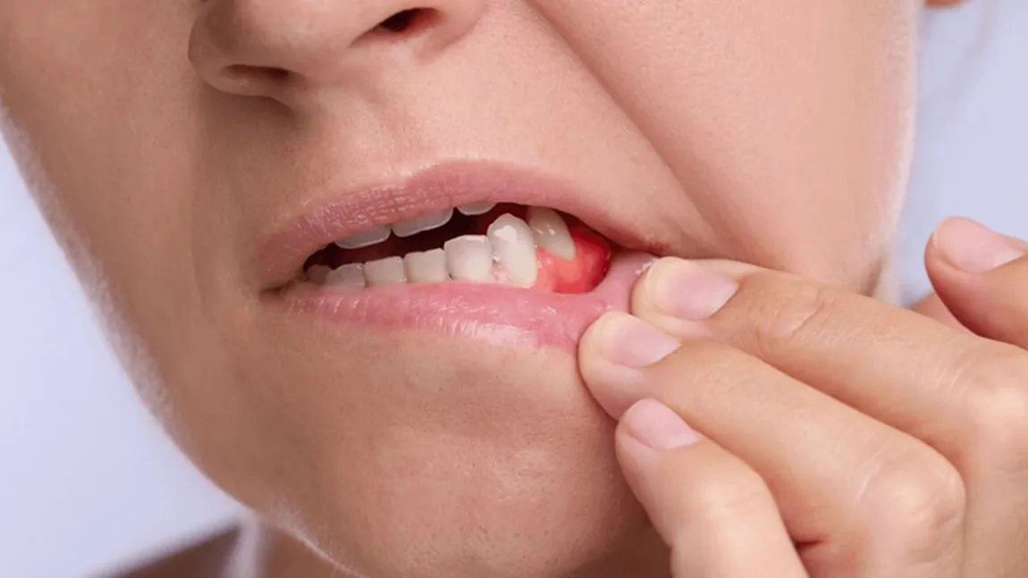 Sângerarea gingiilor: semn banal sau primul indiciu al unei probleme parodontale?
