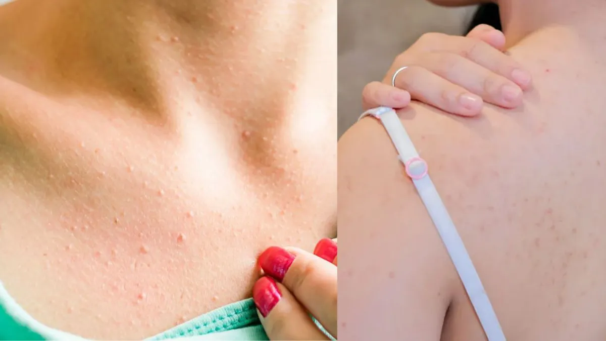 Adio, coșuri pe corp! Metoda care îți curăță pielea mai repede decât ai crede