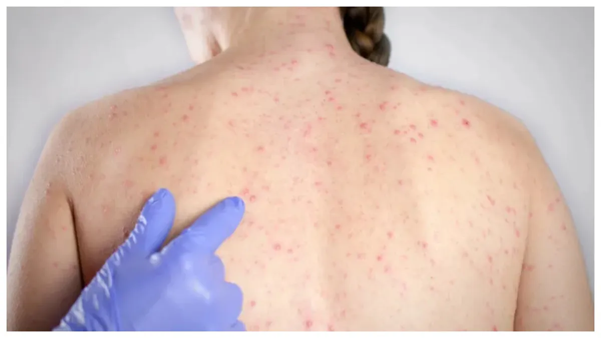 Alertă de rujeolă în România. Țara noastră înregistrează 85% din totalul cazurilor din Europa