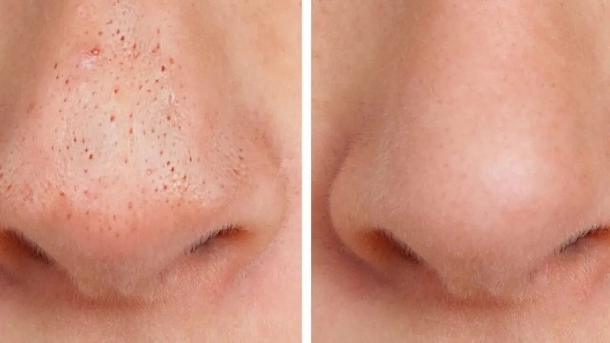 Exfoliantul natural de 7 lei care elimină punctele negre. Truc eficient pentru un ten curat, fără produse scumpe