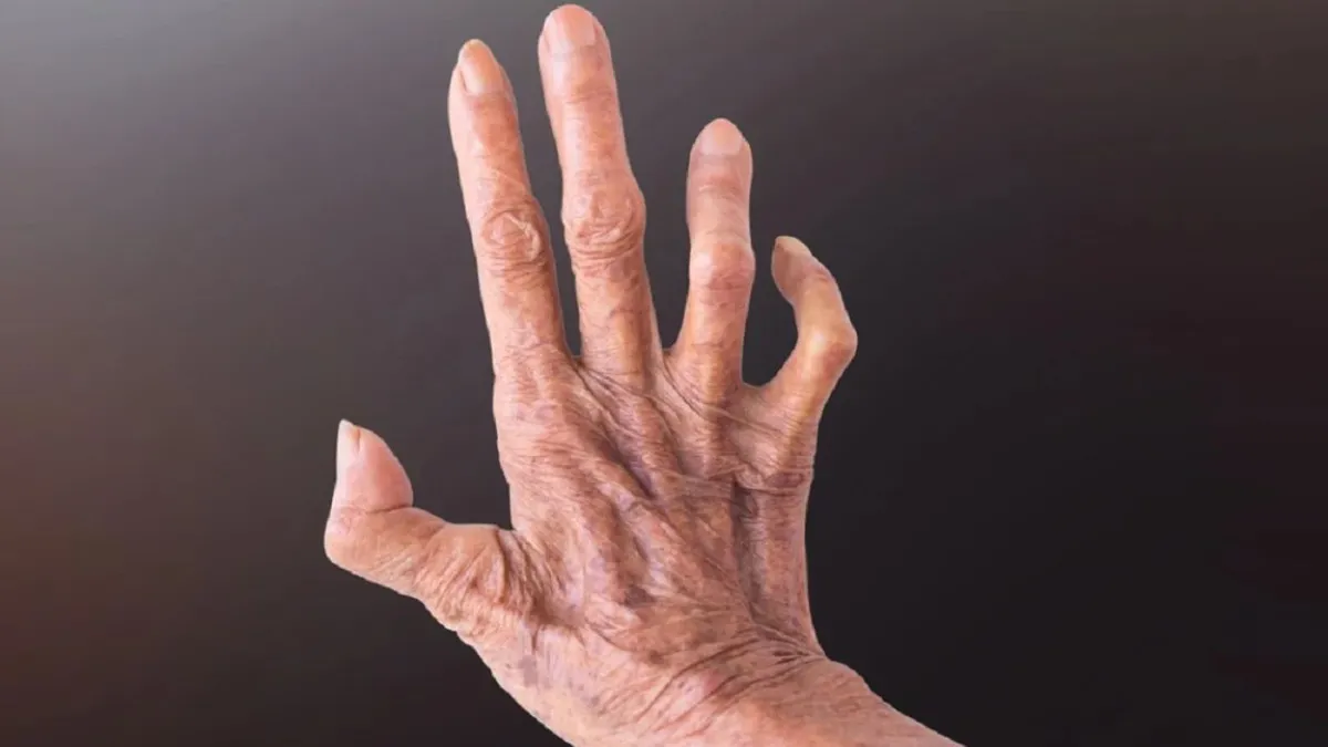 Al doilea caz de lepră confirmat la Cluj. Patru angajate ale unui salon SPA, investigate. Autoritățile spun că riscul pentru populație este minim