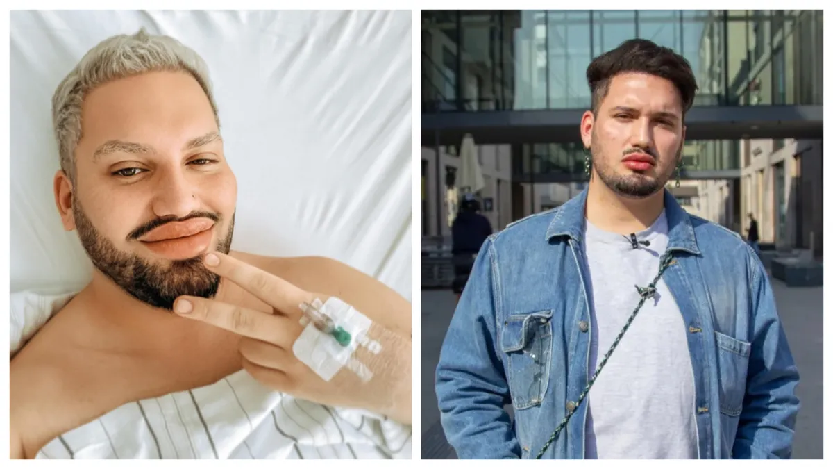 Cine este bărbatul cu peste 100 de intervenții estetice. Vreau să am cele mai mari buze din lume