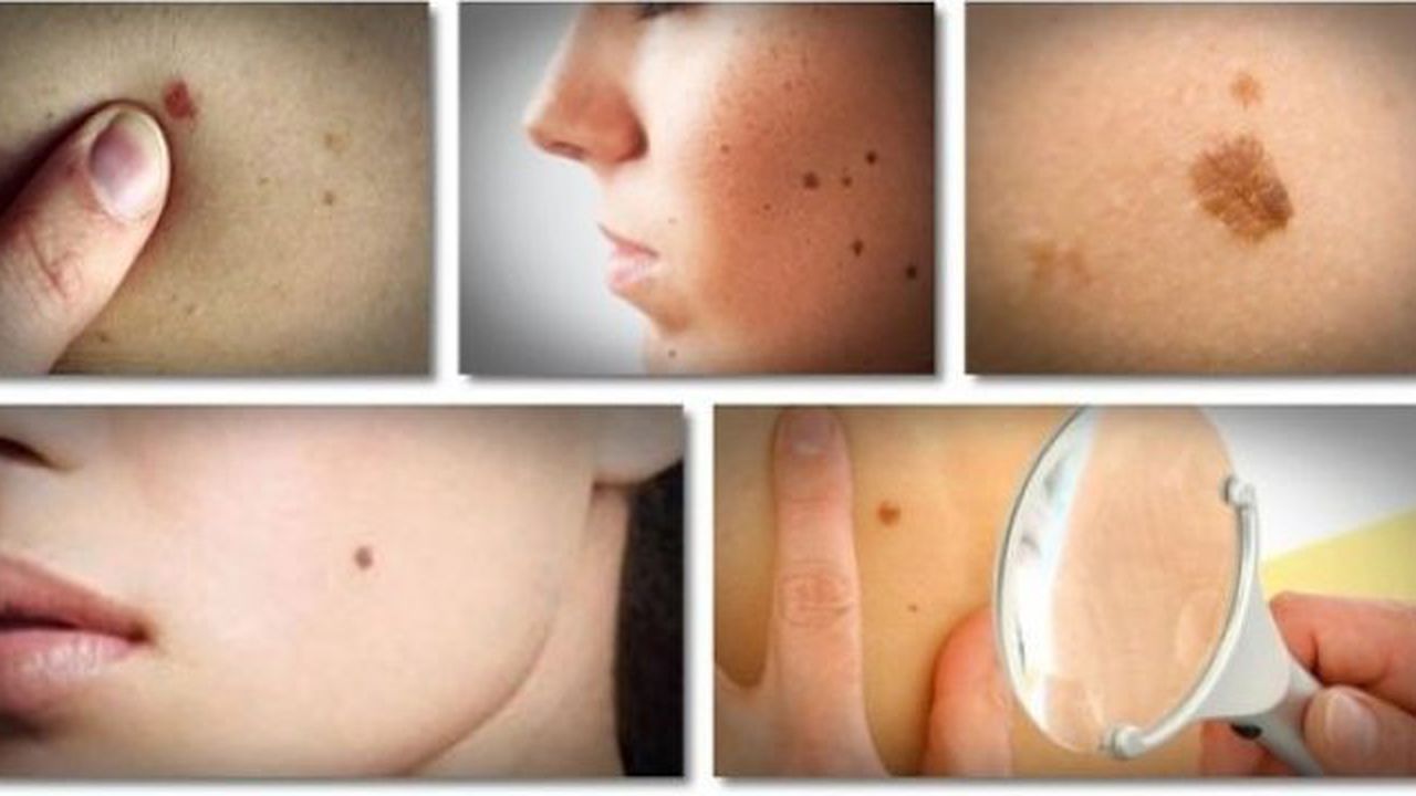 SoluÅ£ia NaturalÄ Care Te ScapÄ De Negi Si Petele Maronii Are Efecte Miraculoase