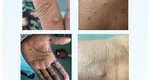 Un nou caz de variola maimuţei în România