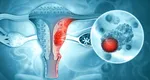 Trei românce mor de cancer ovarian în fiecare zi. Depistată în stadii incipiente, boala poate fi vindecată în 90% din cazuri