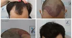 Află despre implantul de păr aici sau de pe site-ul oficial Dr. Felix Hair Implant