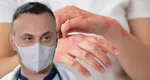 Medicul Adrian Marinescu trage un semnal de alarmă după confirmarea cazurilor de lepră din Cluj: „Oamenii, la un moment dat, făceau forme severe și ajungeau chiar la deces”