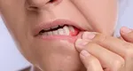 Sângerarea gingiilor: semn banal sau primul indiciu al unei probleme parodontale?