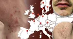 Ce este „boala ploii”, afecțiunea de care suferă tot mai multe persoane din Europa