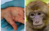 Variola maimuţei stârneşte panică în lume. OMS convoacă o întâlnire de urgenţă