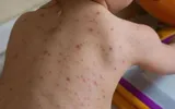 Focar de rujeolă într-o școală din București. Medic: ”Avem copii cu insuficiență respiratorie, avem complicații la nivelul digestiv, cu hepatite, pancreatite, dar cele mai de temut sunt cele neurologice”