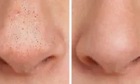 Exfoliantul natural de 7 lei care elimină punctele negre. Truc eficient pentru un ten curat, fără produse scumpe