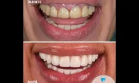 Ce trebuie să știe pacienții despre implantul dentar Fast & Fixed la Dental Premier București?