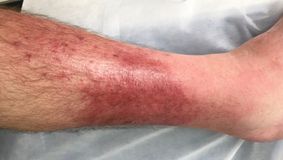 Infecții profunde ale pielii: cauze și tratament