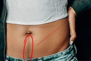 Linea nigra, linia secretă care apare pe abdomen în timpul sarcinii și nu doar