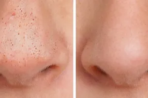 Exfoliantul natural de 7 lei care elimină punctele negre. Truc eficient pentru un ten curat, fără produse scumpe