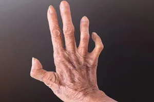 Al doilea caz de lepră confirmat la Cluj. Patru angajate ale unui salon SPA, investigate. Autoritățile spun că riscul pentru populație este minim