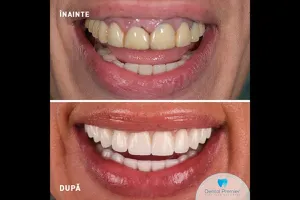 Ce trebuie să știe pacienții despre implantul dentar Fast & Fixed la Dental Premier București?