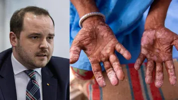 Ministrul Sănătății anunță confirmarea unui caz de lepră la Cluj-Napoca, primul de după 1981