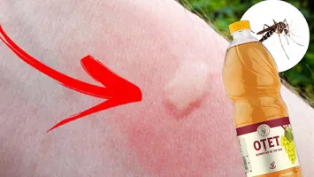 Motivul pentru care se recomandă să aplici oțet pe înțepăturile de țânțar. Remedii naturale rapide care calmează mâncărimile