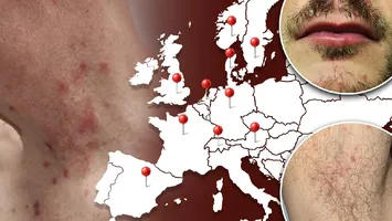 Ce este „boala ploii”, afecțiunea de care suferă tot mai multe persoane din Europa