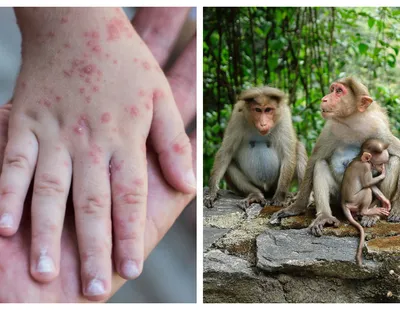 „Variola maimuţei”, boala care face ravagii în Anglia. Ce simptome au bolnavii infectaţi cu virusul care îi sperie pe epidemiologi