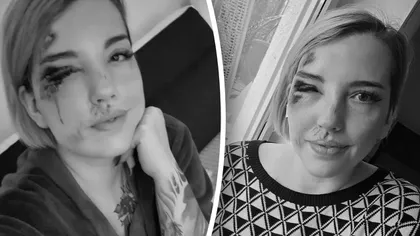 O influenceriță româncă stabilită în Germania a apărut cu fața desfigurată pe internet: „Aveți idee cu ce m-aș putea da să se retragă umflătura?”