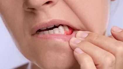 Sângerarea gingiilor: semn banal sau primul indiciu al unei probleme parodontale?