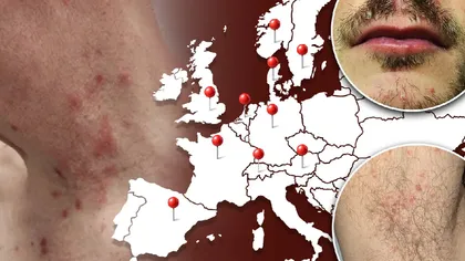 Ce este „boala ploii”, afecțiunea de care suferă tot mai multe persoane din Europa