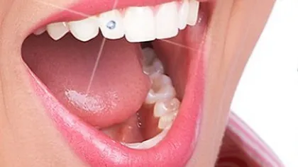 Dantura poate fi înfrumuseţată cu ajutorul strasurilor aplicate pe dinţi