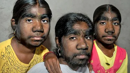 Trei surori din India suferă de 