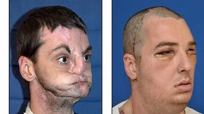 A primit o faţă nouă, după 15 ani cât a stat cu mască, prin cea mai lungă operaţie de transplant